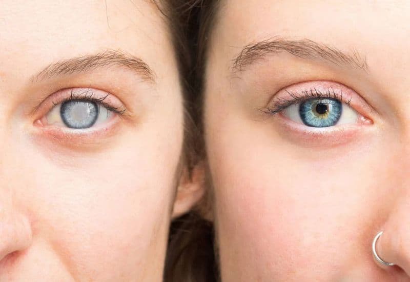 viêm võng mạc sắc tố