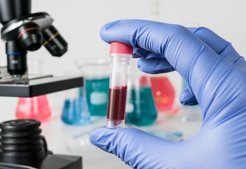 Xét nghiệm máu nhằm kiểm tra đường huyết, testosterone và các yếu tố bệnh lý liên quan