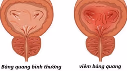 Tiểu ra máu bị gì? Có nguy hiểm không và phải làm sao?