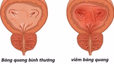 Tiểu ra máu bị gì? Có nguy hiểm không và phải làm sao?