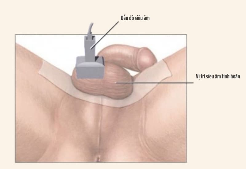 Siêu âm Doppler hỗ trợ đánh giá cấu trúc và dòng máu đến tinh hoàn để tìm nguyên nhân gây đau