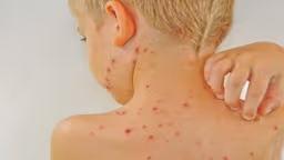 Các biến chứng sốt virus nguy hiểm: Nhận biết sớm để bảo vệ sức khỏe