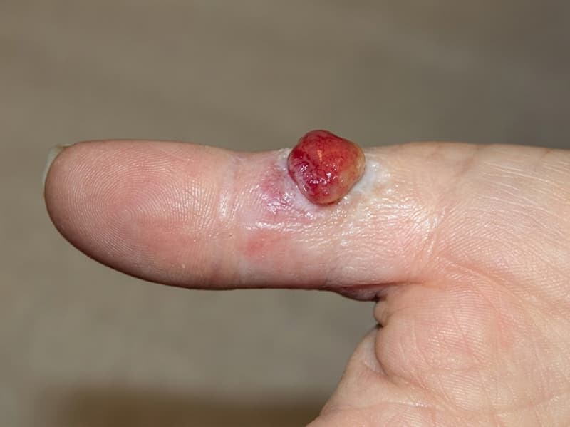 Các vị trí thường gặp của u hạt nhiễm khuẩn.