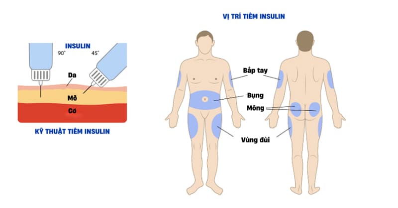 Kỹ thuật tiêm insulin cho người bệnh tiểu đường