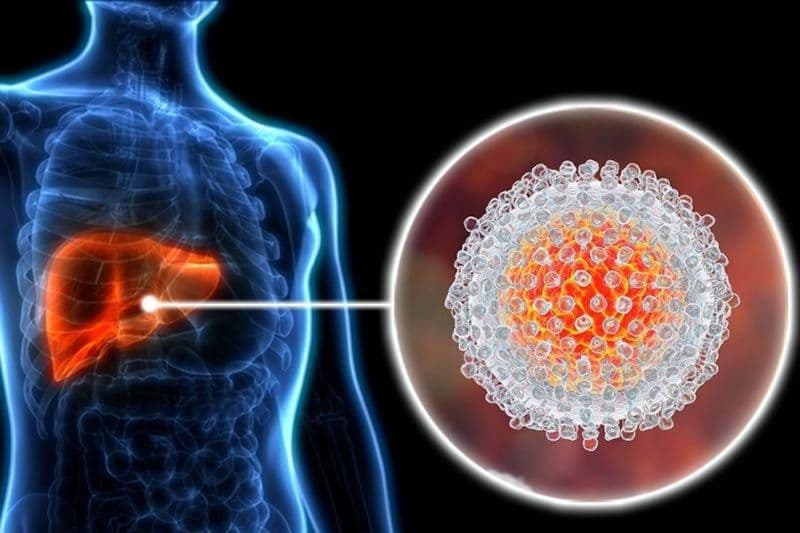 Viêm gan siêu vi cấp có thể diễn biến với triệu chứng nhẹ hoặc thậm chí không có triệu chứng