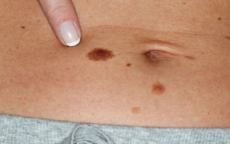 Bất thường trên da cũng là dấu hiệu ung thư sớm