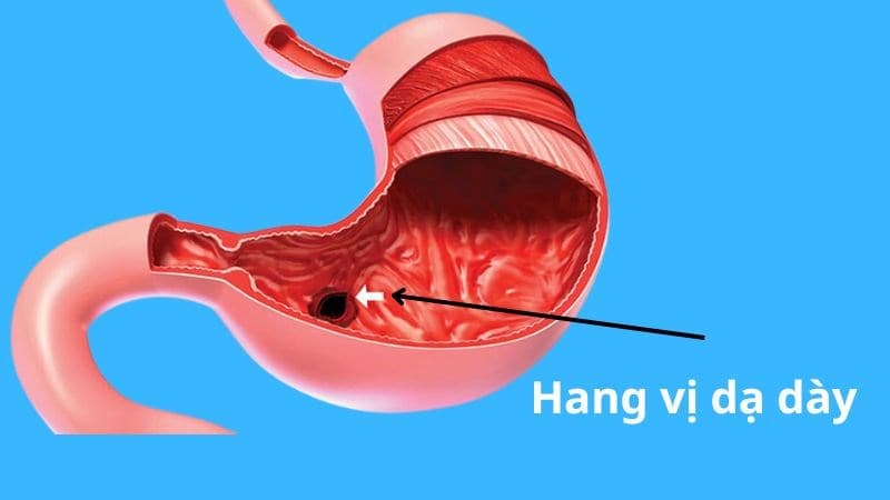 Niêm mạc dạ dày bị kích thích gây nên tình trạng xung huyết