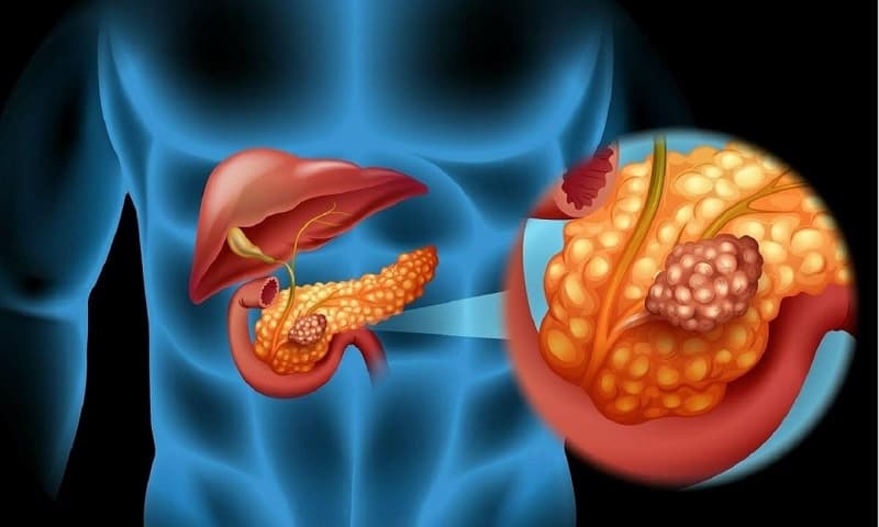 Tụy là một cơ quan nằm phía sau dạ dày, vừa tham gia tiêu hóa thức ăn, vừa đảm nhiệm chức năng nội tiết và điều hòa đường huyết