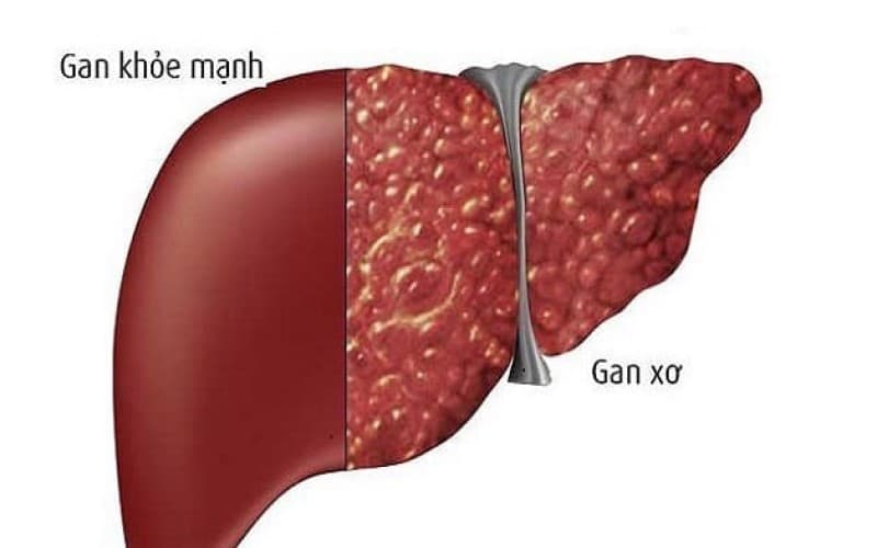 Các phương pháp xét nghiệm xơ gan và chẩn đoán xơ gan