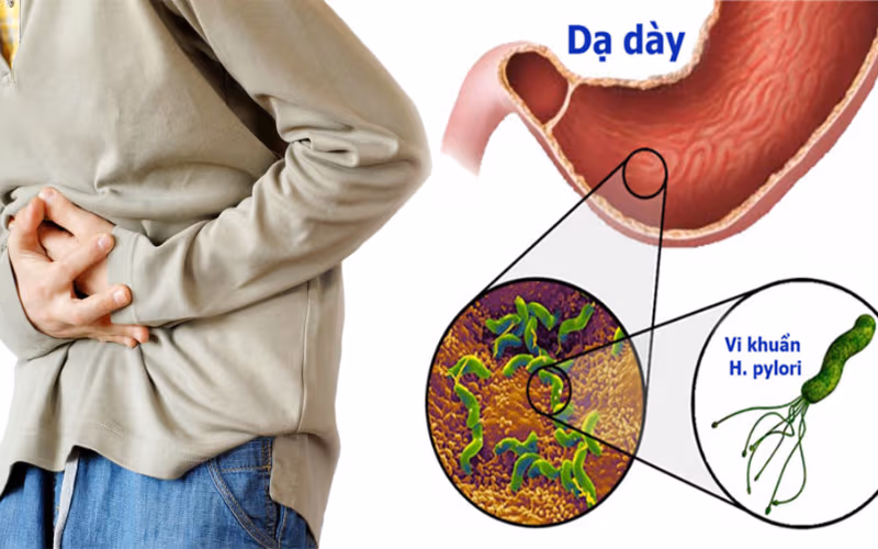 Viêm dạ dày HP là gì? Thông tin chi tiết