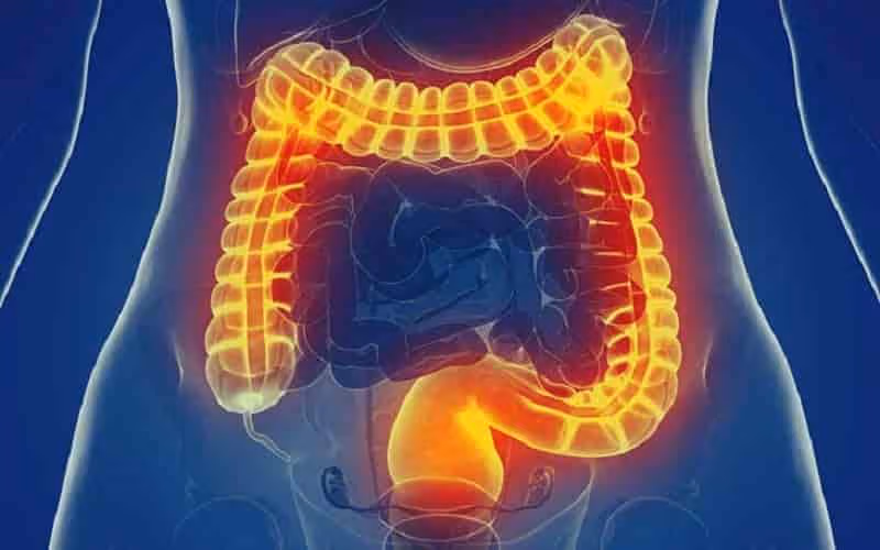Hội chứng ruột kích thích là rối loạn tiêu hóa mạn tính, thường tái phát