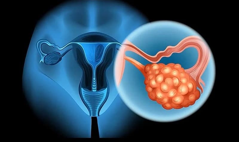 ROMA tiền mãn kinh là chỉ số được sử dụng để đánh giá nguy cơ ung thư buồng trứng