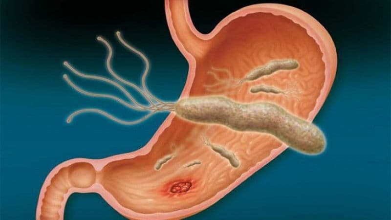 Khi dạ dày nhiễm khuẩn H. pylori, vi khuẩn có thể làm tổn thương hàng rào bảo vệ niêm mạc và gây viêm