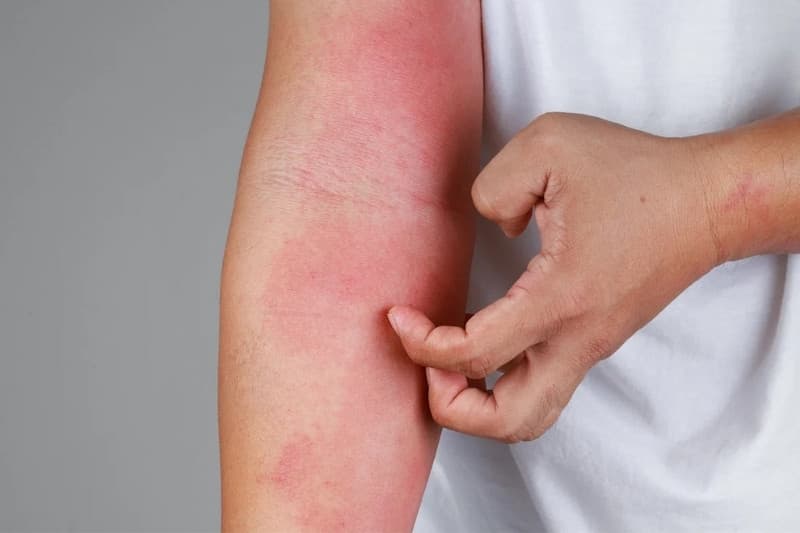 Tôm thuộc nhóm động vật có vỏ có thể gây dị ứng ở một số người