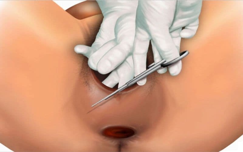 Thủ thuật thường tiến hành khi đầu thai đã xuống thấp và tầng sinh môn đang căng tối đa