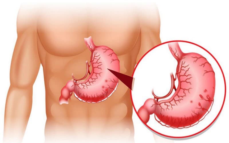 Khi dạ dày đau lâm râm, người bệnh không nên chỉ tập trung vào việc làm dịu cơn đau mà cần tìm hiểu nguyên nhân gây ra triệu chứng