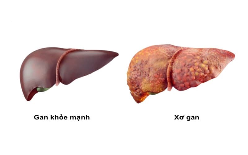 Xét nghiệm tầm soát xơ gan khi có dấu hiệu bất thường