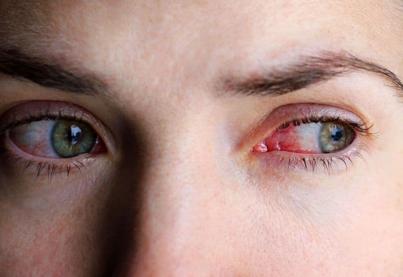 làm sao để hết đỏ mắt nhanh nhất