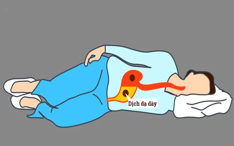 Nằm nghiêng trái giúp giảm trào ngược dạ dày