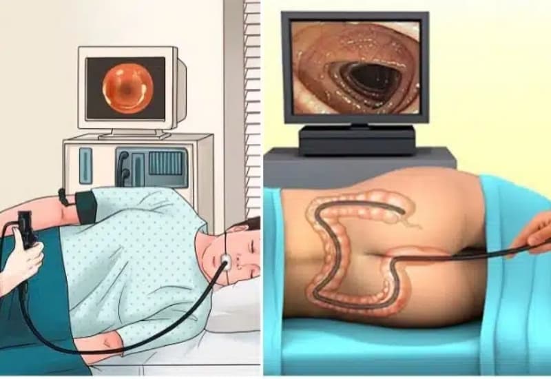 Nội soi dạ dày và đại tràng có yêu cầu chuẩn bị khác nhau