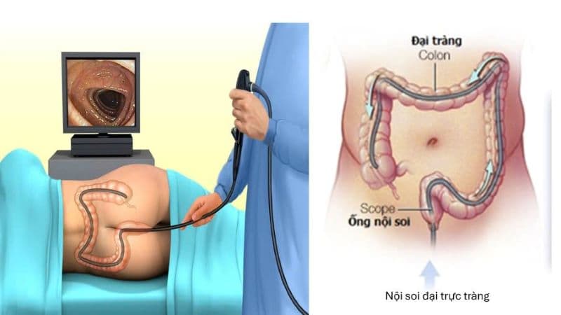 Các bước nội soi đại tràng không gây mê cần thực hiện chuẩn y khoa