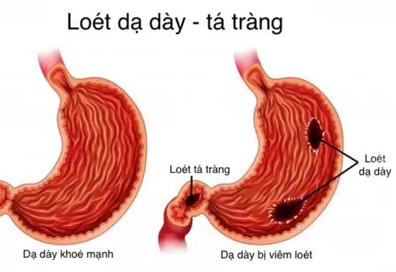 Nội soi giúp bác sĩ quan sát trực tiếp niêm mạc dạ dày – tá tràng, xác định vị trí và mức độ tổn thương.