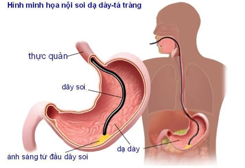 Nội soi tiêu hóa giúp quan sát trực tiếp niêm mạc đường tiêu hóa