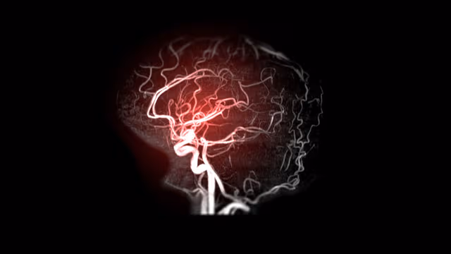 Phình mạch máu não có phải mổ không, điều trị thế nào?