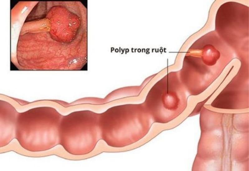 Polyp đại tràng được phát hiện qua nội soi