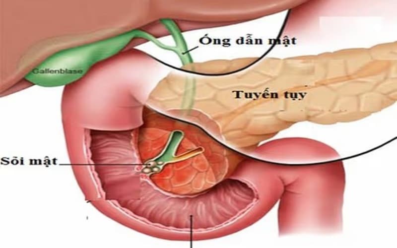 Rò dịch tụy là một trong những biến chứng có thể gặp khi phẫu thuật sỏi tụy