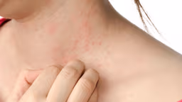 Sẩn ngứa do gan: Nguyên nhân, dấu hiệu nhận biết và cách xử lý