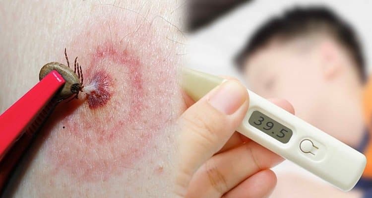 Giai đoạn đầu, trẻ thường sốt cao đột ngột kèm đau đầu, đau mỏi, mệt, chán ăn hoặc buồn nôn.
