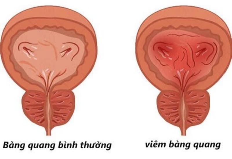 Tình trạng bàng quang viêm có thể gây tiểu máu