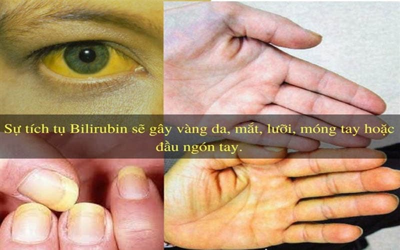 Vàng da là dấu hiệu rối loạn chức năng gan thường gặp