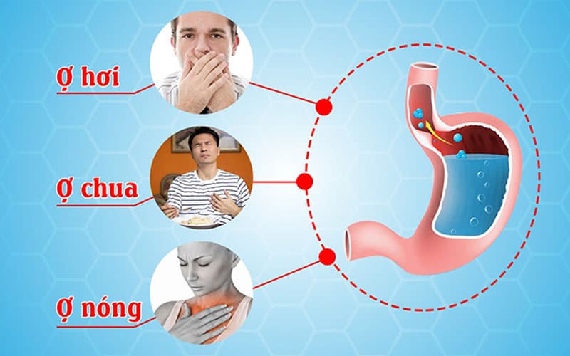 Ợ nóng, ợ chua là các triệu chứng thường gặp của tràn dịch dạ dày