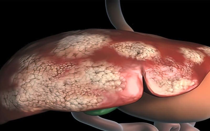 Ung thư gan giai đoạn cuối sống được bao lâu?
