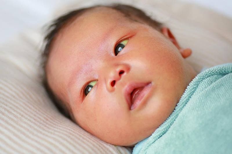 Vàng da nhân não (kernicterus) là tình trạng tổn thương não do bilirubin tự do tăng quá cao trong máu và xâm nhập vào mô não