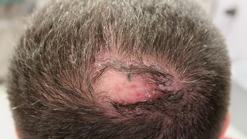 Viêm gan B có bị rụng tóc không? Nguyên nhân và cách hạn chế rụng tóc ở người bị viêm gan B