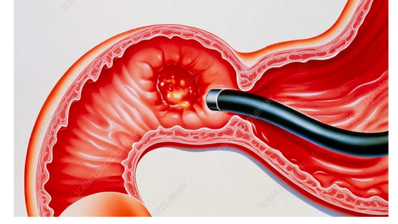 Viêm tá tràng là gì? Nguyên nhân, triệu chứng và điều trị như thế nào?