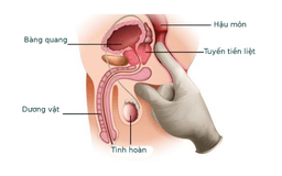 Điều trị viêm tuyến tiền liệt: Phương pháp, chi phí & thời gian