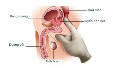 Điều trị viêm tuyến tiền liệt: Phương pháp, chi phí & thời gian