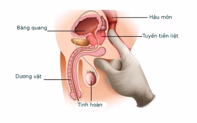 Điều trị viêm tuyến tiền liệt: Phương pháp, chi phí & thời gian