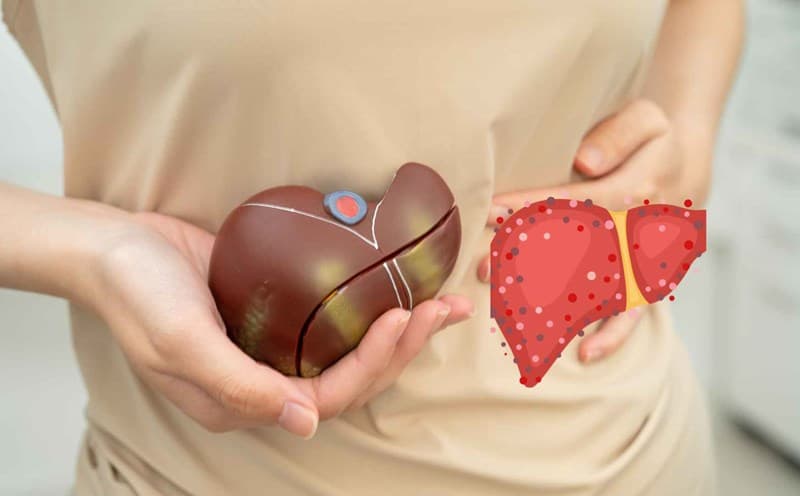 Men gan tăng không đồng nghĩa chắc chắn với viêm gan siêu vi cấp