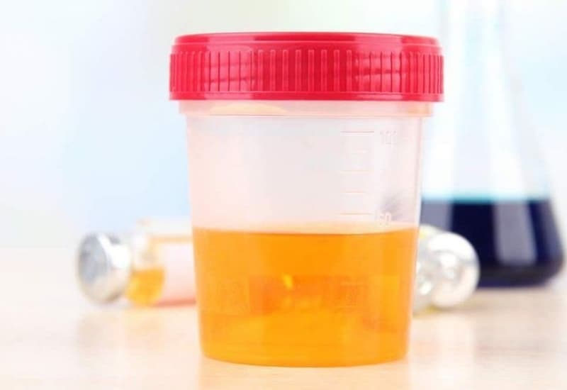 Xét nghiệm nước tiểu hỗ trợ chẩn đoán viêm tuyến tiền liệt