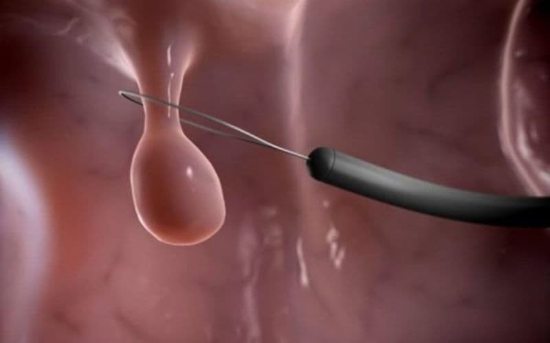 Dấu hiệu nhiễm trùng sau xoắn polyp cổ tử cung cần lưu ý gồm dịch âm đạo có mùi hôi, màu sắc bất thường, sốt hoặc đau vùng hạ vị tăng lên.