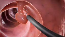 Có sao không khi xoắn polyp cổ tử cung bị chảy máu và cách xử lý