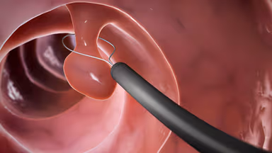 Có sao không khi xoắn polyp cổ tử cung bị chảy máu và cách xử lý