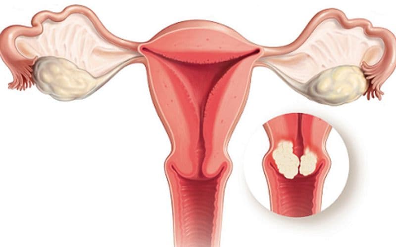 Xoắn polyp là kỹ thuật dùng dụng cụ chuyên khoa để giữ phần thân hoặc cuống polyp, sau đó xoắn có kiểm soát cho đến khi khối polyp tách khỏi vị trí bám