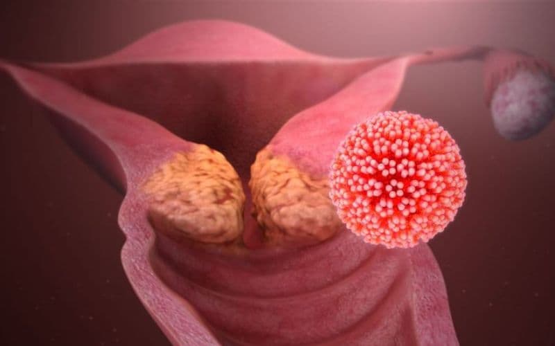 Chăm sóc sau xoắn polyp cổ tử cung đúng cách giúp hạn chế nguy cơ nhiễm trùng và hỗ trợ cổ tử cung hồi phục.
