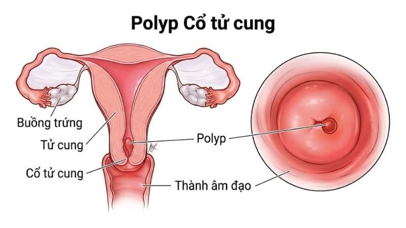 Polyp cổ tử cung đa phần lành tính, nguy cơ ung thư rất thấp nhưng vẫn cần thăm khám khi phát hiện bất thường.